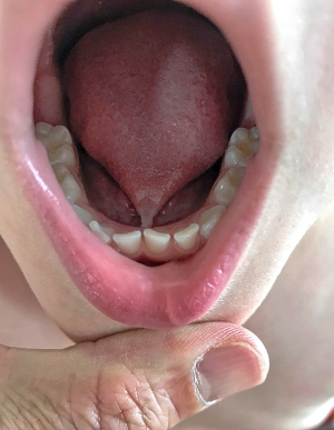 Close-up of tongue tie